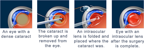 credit Reizende handelaar Ijver Cataract Surgery Eugene | Cataract Treatment Bend OR | Cataracts OR |  Mobile Website